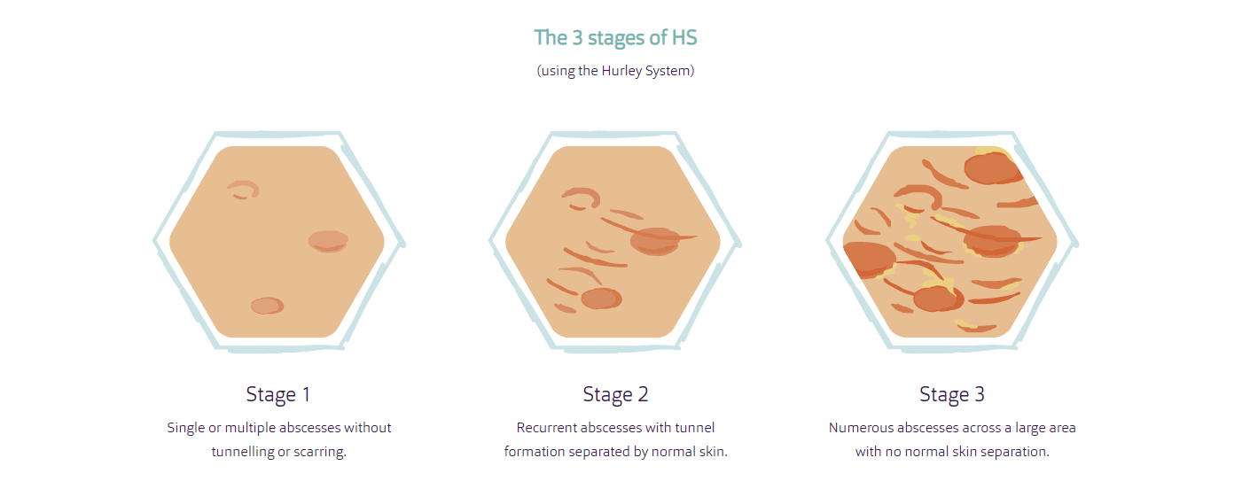 The 3 stages of HS as by the Hurley System