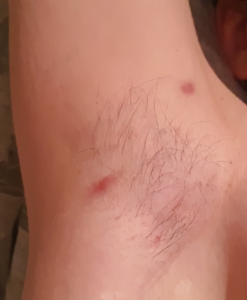 hidradenitis suppurativa picture armpit stage 1