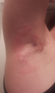 hs armpit stage 1 