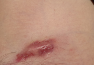 hidradenitis suppurativa picture groin