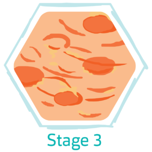 Hidradenitis Suppurativa Stage 3