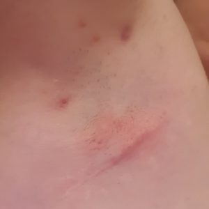 HS Flare beginning