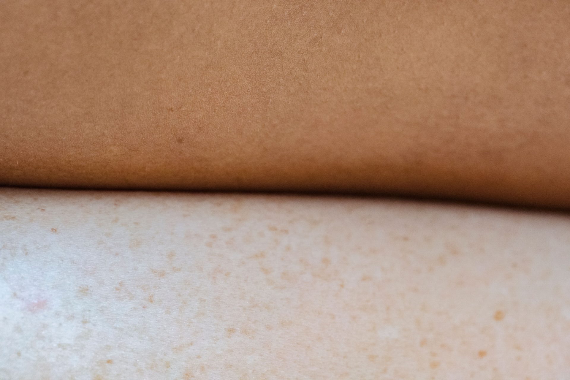 Gentle daily wound care routine for hidradenitis suppurativa